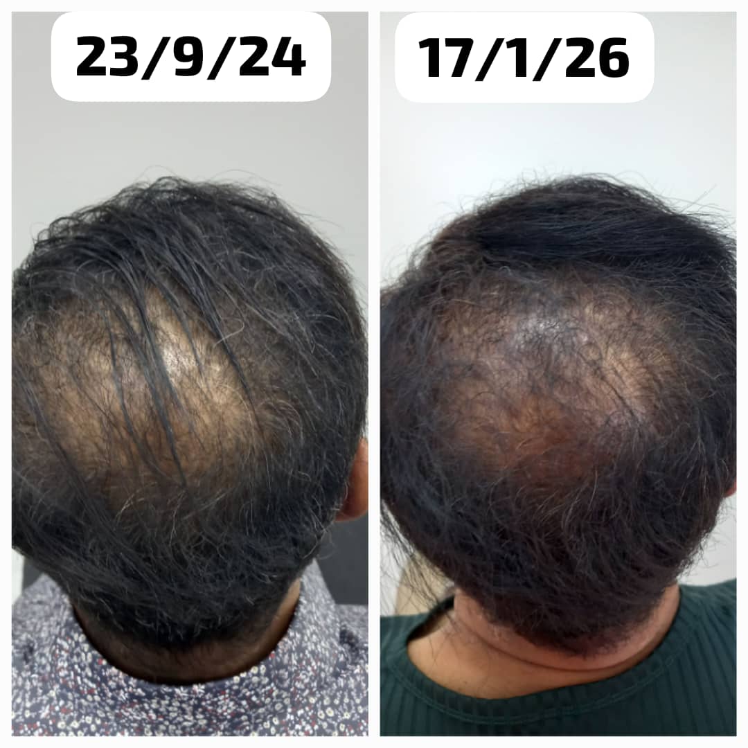 Hair loss treatment before and after showing regrowth